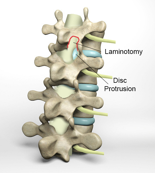 Lumbar Disc Herniation Spine Orthobullets